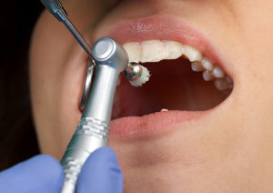 Teeth cleaning includes polishing