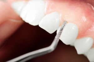 Dentist administering gum disease treatment