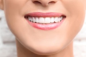 Woman smiles after a successful teeth bonding